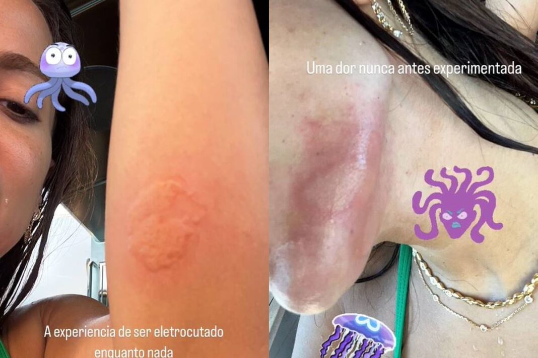 anitta-sofre-acidente-em-viagem:-“uma-dor-que-nunca-senti-na-vida”