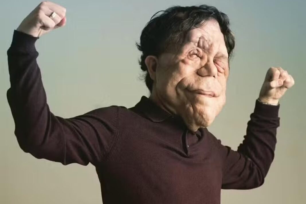 quem-e-adam-pearson,-ator-que-fez-39-cirurgias-e-tem-rosto-desfigurado